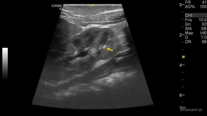 Obraz kamicy w badaniu ultrasonograficznym