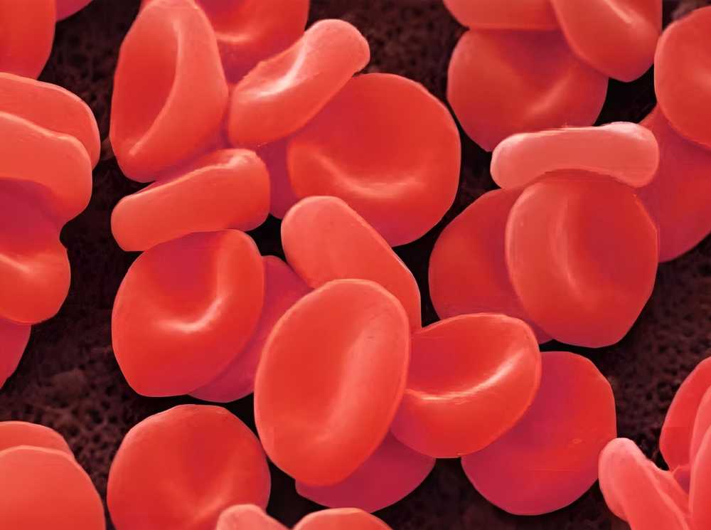 Niski poziom płytek krwi – jak wpływa na Twoje samopoczucie i co możesz zrobić?